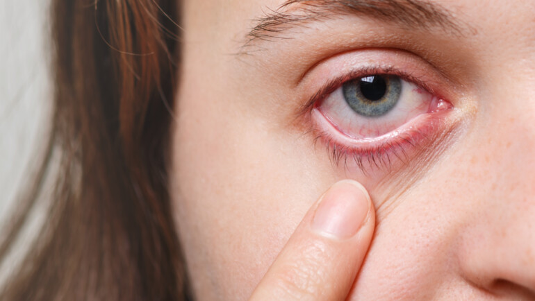 ¿Cuándo acudir al médico si presentas “ojo rojo”?