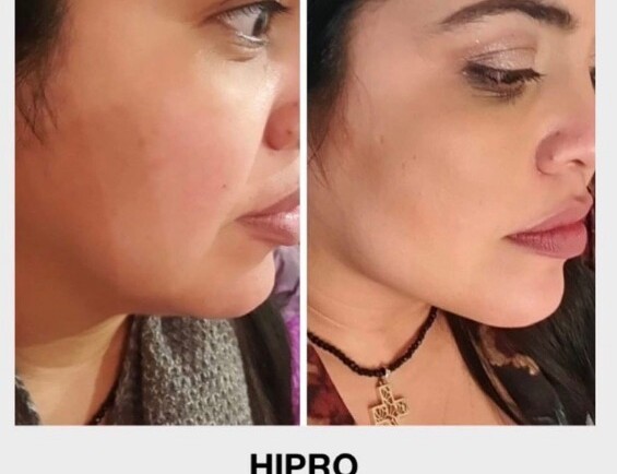 HIFU, los secretos de la bichectomía ultrasónica