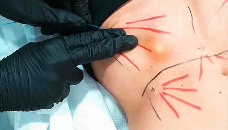 NUEVO: ENDOLYSE Abdominal – Resultados visibles sin cirugía¡ Dile adiós a la grasa localizada y la flacidez abdominal de forma rápida, segura y efectiva!