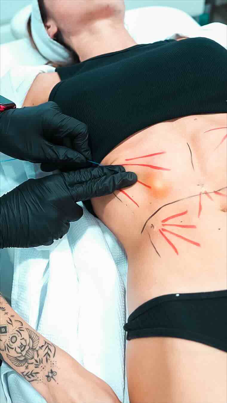 NUEVO: ENDOLYSE Abdominal – Resultados visibles sin cirugía¡ Dile adiós a la grasa localizada y la flacidez abdominal de forma rápida, segura y efectiva!